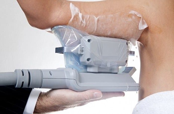 fat freezing arms Barrow