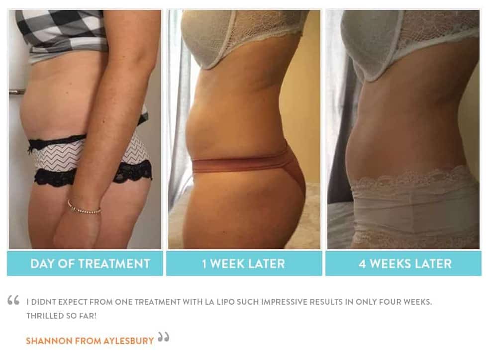 before, Cryolipolysis Barrow