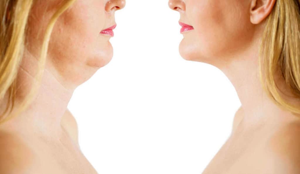 Double Chin treatment Barrow before and after results