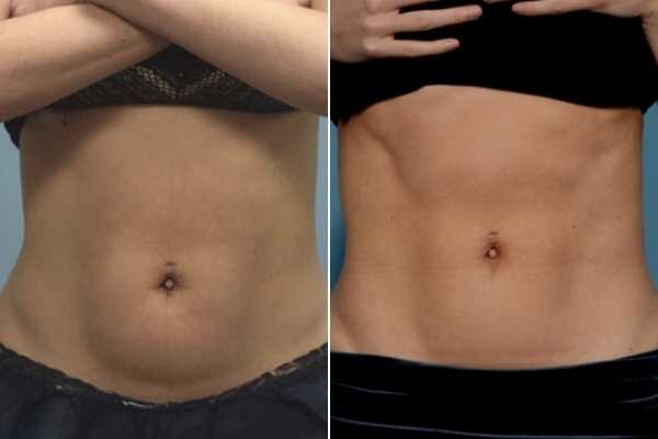 body sculpting FAQs Barrow
