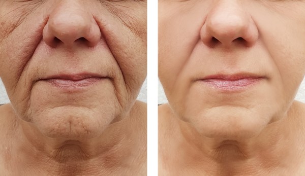 Learn more about Morpheus8 Treatment Barrow today!