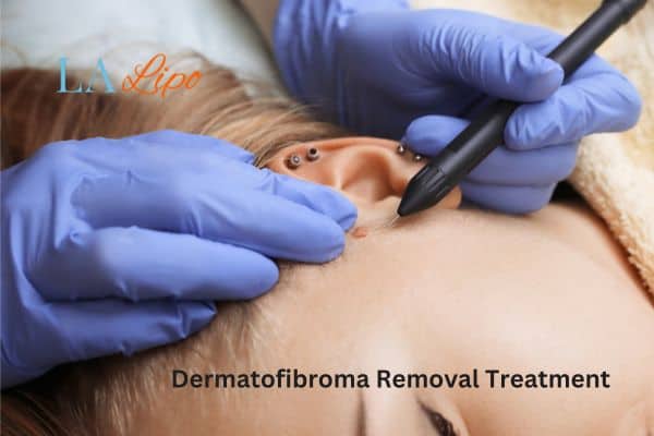 Dermatofibroma Removal Treatment Barrow