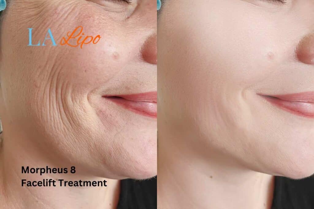 Morpheus8 Treatment Barrow for flawless skin! Call us today!