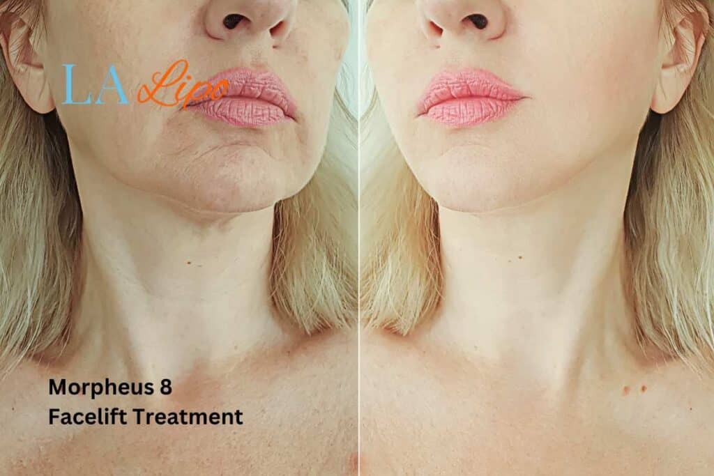 Turn back time with Morpheus8 Treatment Barrow
