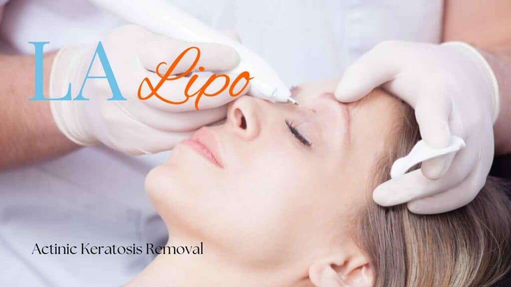 actinic keratosis removal Barrow