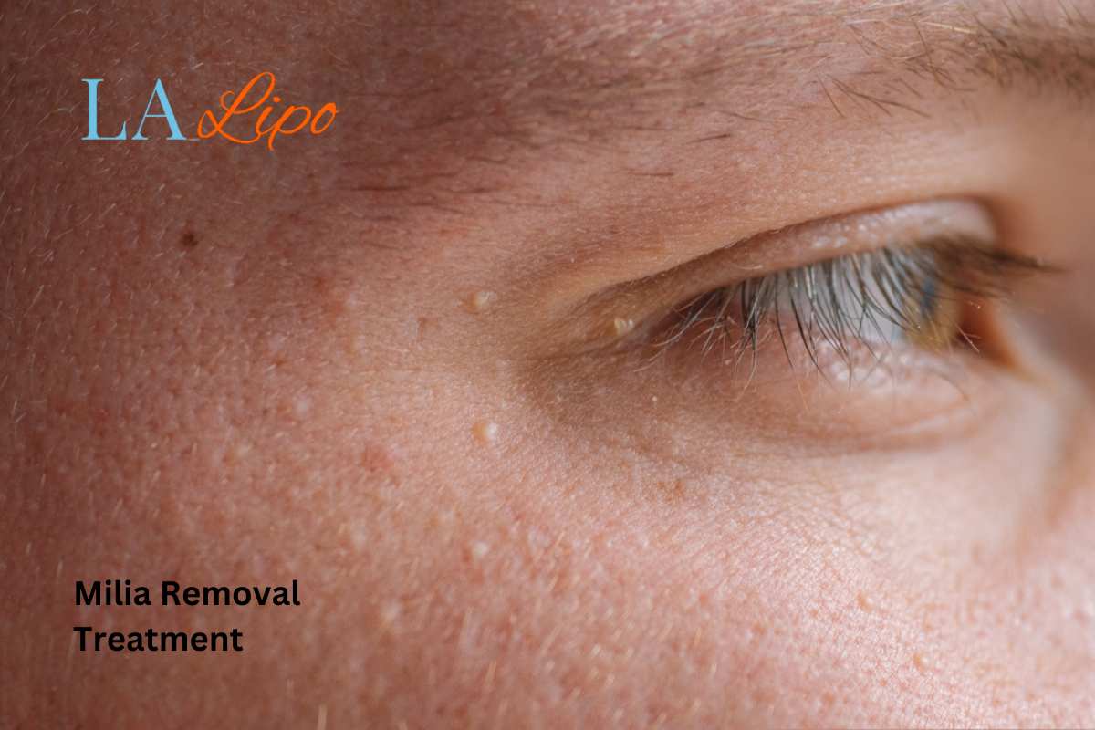 Cryopen Milia Removal: Is It the Easiest and Safest Option Barrow?