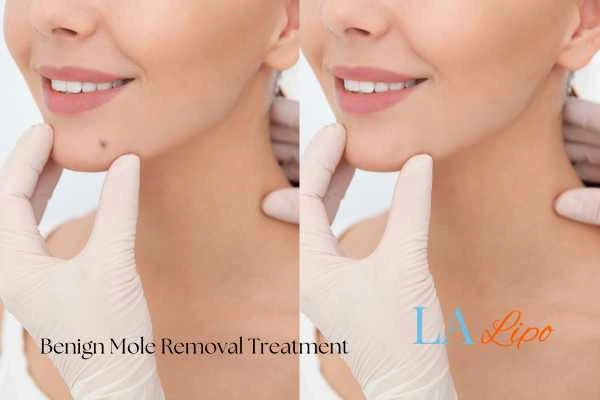 Before-and-after results following benign mole-removal treatment Barrow