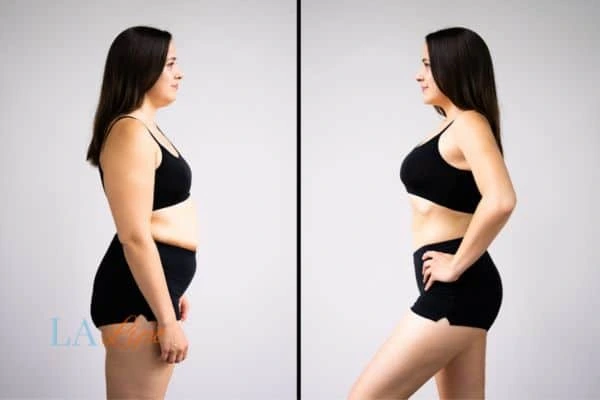 image of woman before and after results of LA-EMS Body Sculpting Barrow to help treat Diastasis recti