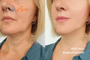 hi-fu for wrinkles Barrow before and after results