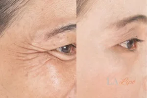 Before and after results of woman - HI-fu wrinkles reduction treatment Barrow