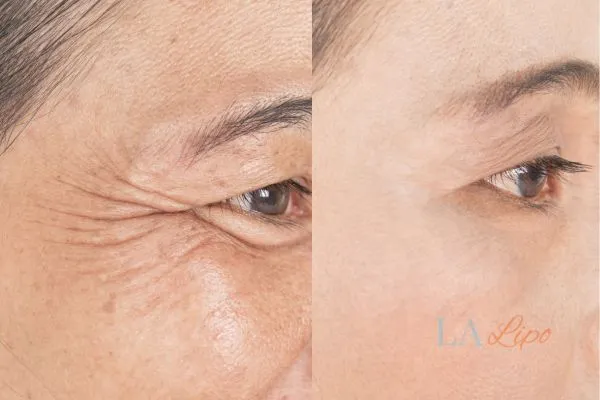 Before and after results of woman - HI-fu wrinkles reduction treatment Barrow