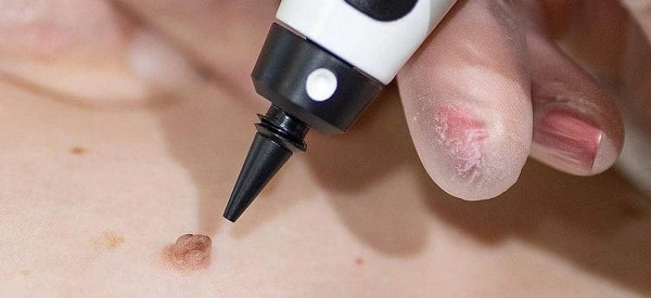 skin tag removal using cryopen Barrow