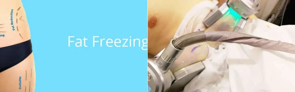 Fat freezing Barrow on multiple areas of the body