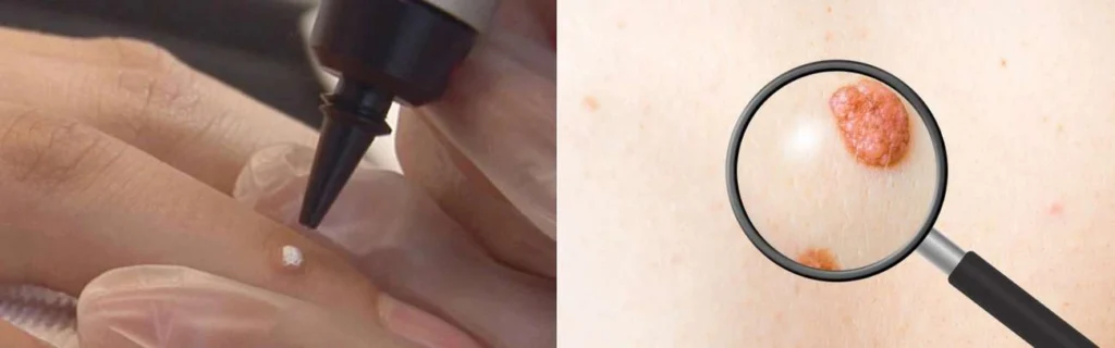 CryoPen practitioner Barrow assessing a benign mole before treatment