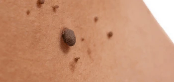 image of a skin tag Barrow