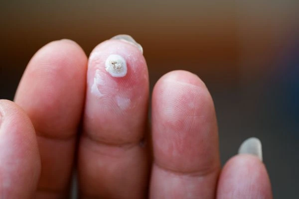 wart on person finger - cryotherapy to treat from LA LIPO Barrow