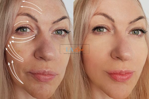 Morpheus 8 results Barrow face lift.