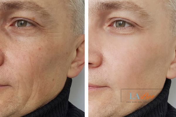 See the amazing results of Morpheus8 Treatment Barrow!