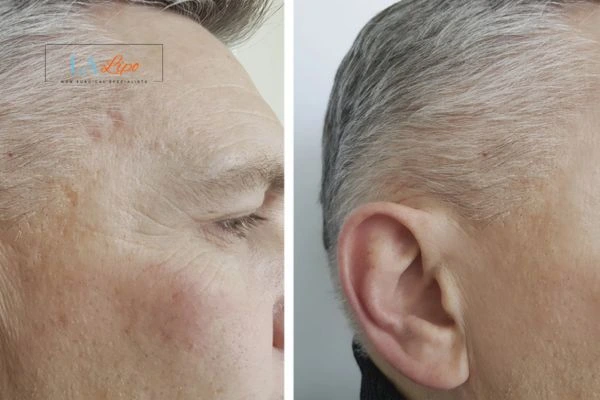 Mens Before & After Morpheus 8 Results Barrow