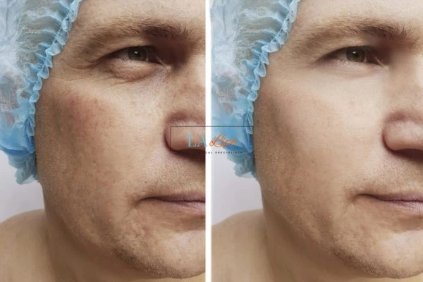 Before and after Morpheus 8 Results Barrow