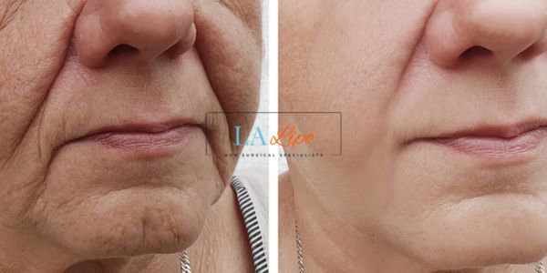 Older lady deeper wrinkle reduction - LA LIPO Morpheus 8 Results Barrow