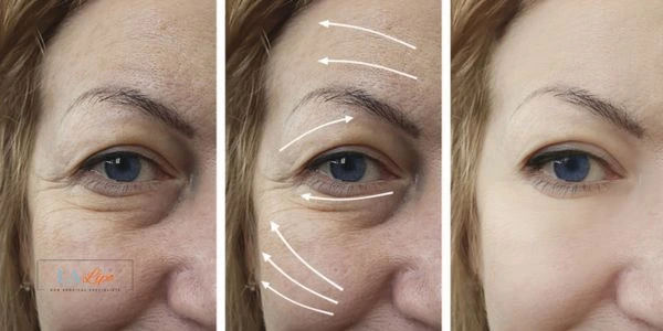 Amazing eye lift Morpheus 8 results Barrow