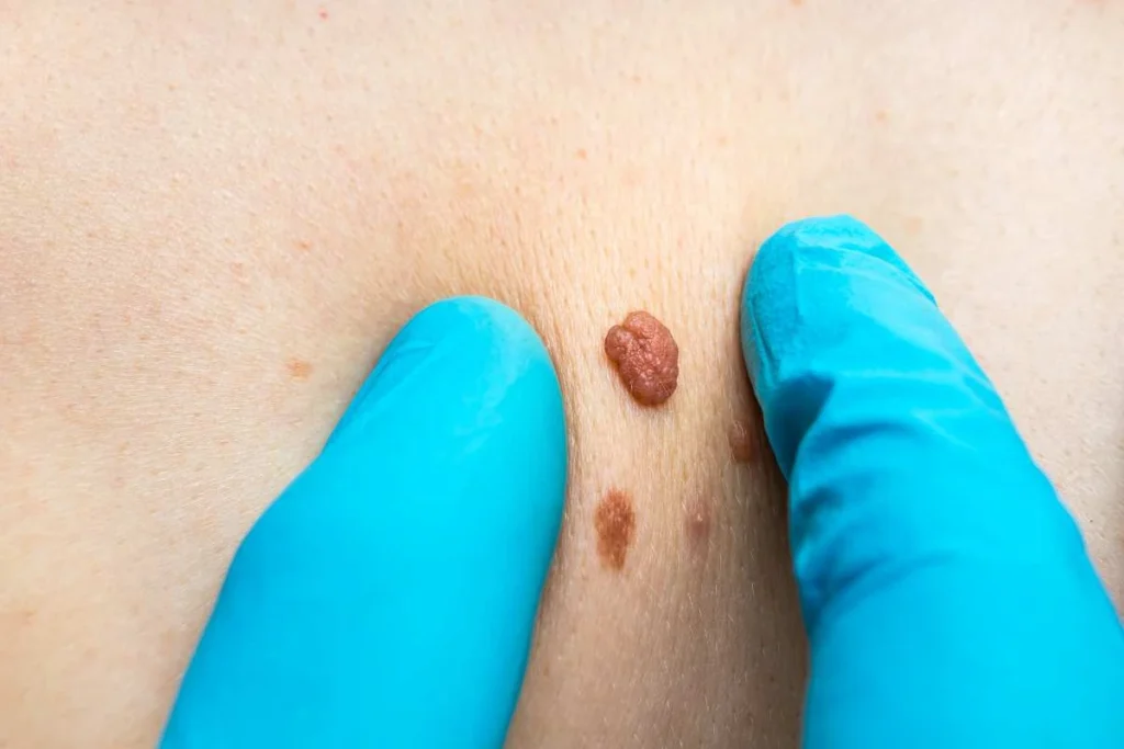 LA LIPO Cryopen Lesion Removal Prices Barrow