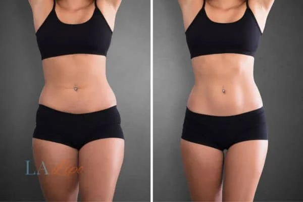 before and after results of non-surgical treatment to help a woman's body image and mental health Barrow