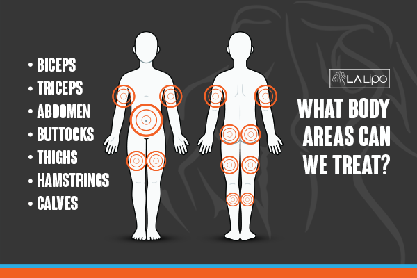 Diagram to show areas you can have LA-EMS Body Sculpting Treatment Barrow