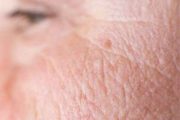 close up picture of a woman's face showing an age spot Barrow