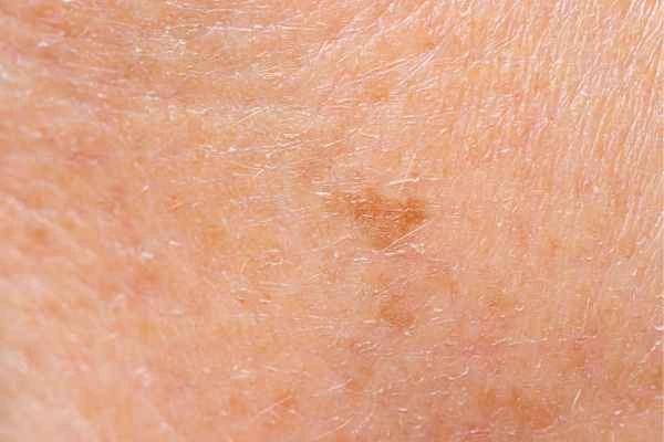 close up picture of age spots Barrow