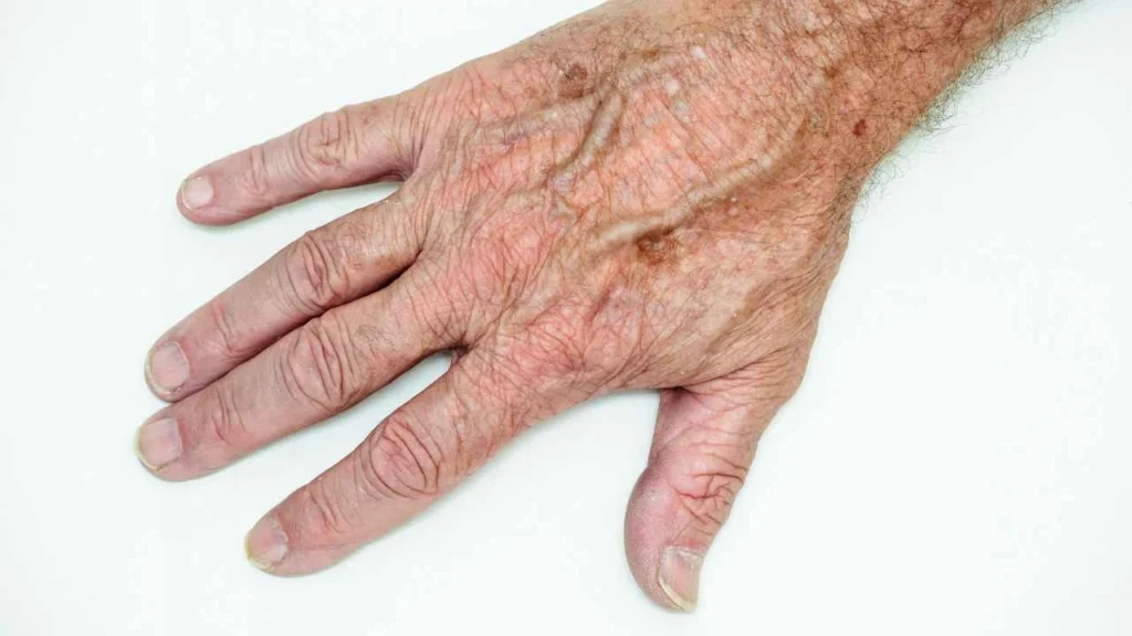 Male hand showing age spot Barrow