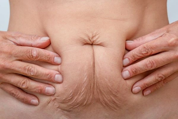 Image of a woman's stomach with loose skin - example of skin tightening Barrow options