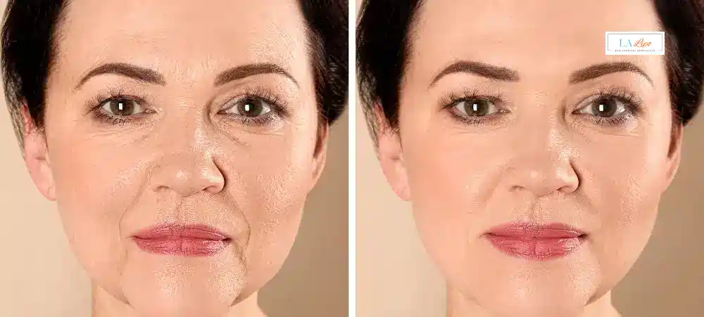 How Long Does It Take to See Results and How Long Do They Last Barrow?