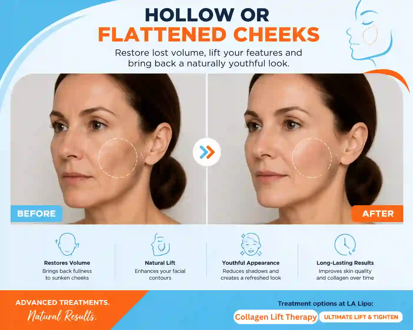 Sign #4: Hollow or Flattened Cheeks Barrow