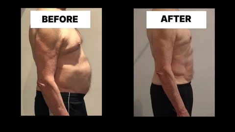 What Symptoms Can Diastasis Recti Cause in Men? Weak Core, Back Pain and Poor Posture Barrow